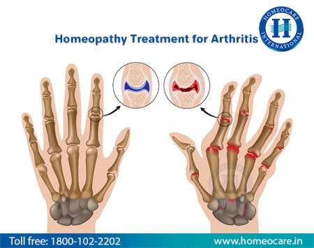 Homeopathy Treatment For Arthritis